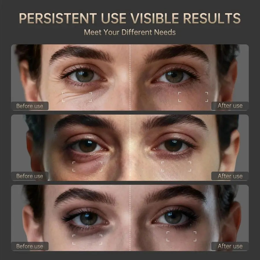 Light Therapy for Eyes, 3 Minutes AroundEyes Red Light Eye Mask, Eye Massager for Reducing Dark Circles and Puffiness, Smoothing